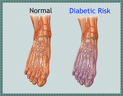 diabetic neuropathy